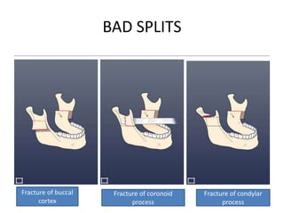 Complications of mandibular orthognathic surgery | PPTX