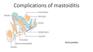 Complications of mastoiditis
Sarita pandey
 