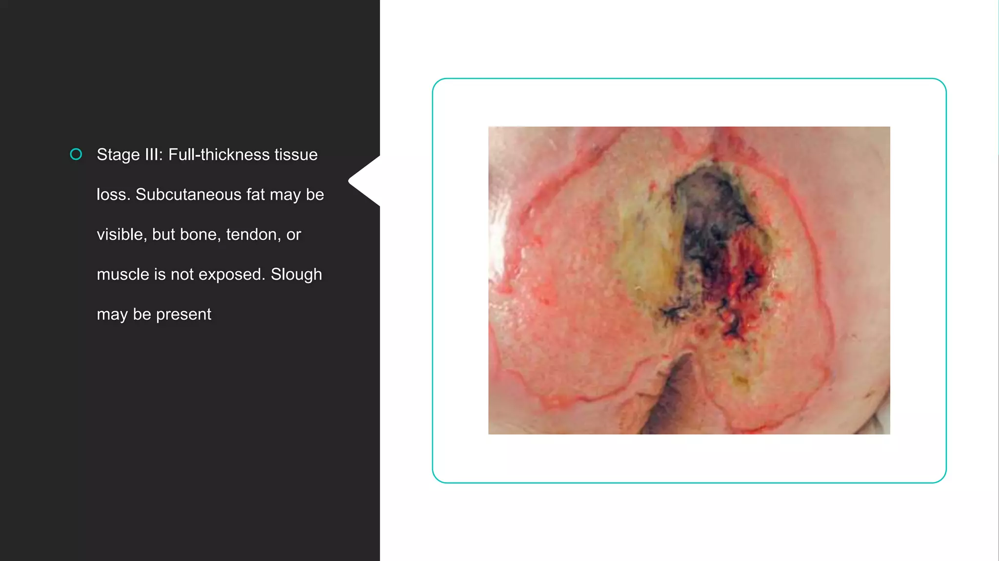 Stage III: Full-thickness tissue
loss. Subcutaneous fat may be
visible, but bone, tendon, or
muscle is not exposed. Slough
may be present
 