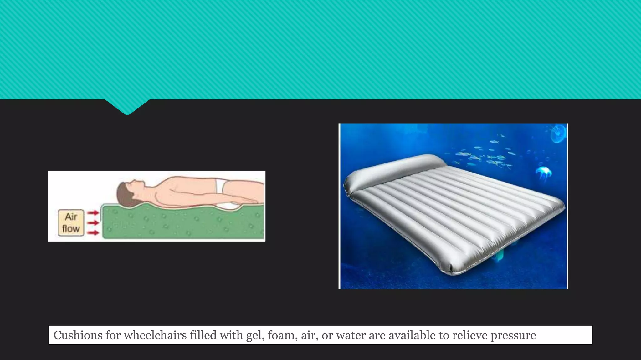 Cushions for wheelchairs filled with gel, foam, air, or water are available to relieve pressure
 