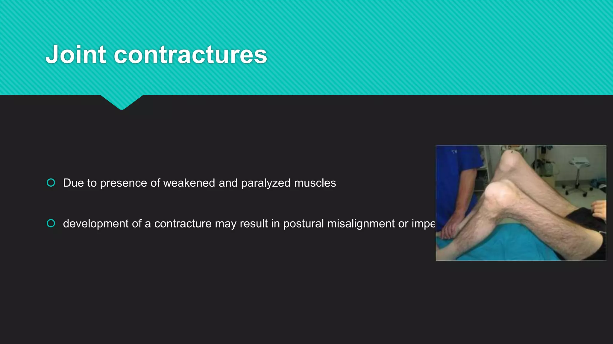 Joint contractures
 Due to presence of weakened and paralyzed muscles
 development of a contracture may result in postural misalignment or impede potential function
 