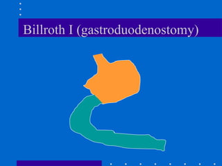 Billroth I (gastroduodenostomy)
 