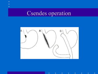 Csendes operation
 