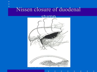 Nissen closure of duodenal
stump
 