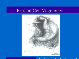 Parietal Cell Vagotomy
 
