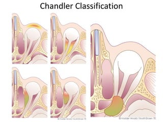 Complications of sinusitis | PPTX