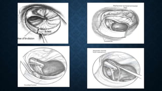 Missing Stapes Complications of stapes surgry | PPTX