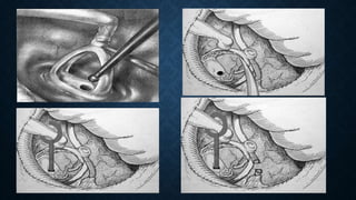 Missing Stapes Complications of stapes surgry | PPTX