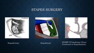 Missing Stapes Complications of stapes surgry | PPTX