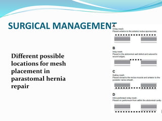 SURGICAL MANAGEMENT
Different possible
locations for mesh
placement in
parastomal hernia
repair
 