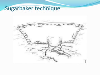 Sugarbaker technique
 