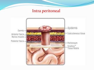 Intra peritoneal
 