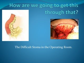 The Difficult Stoma in the Operating Room.
 