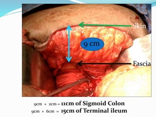 Skin
Fascia
9 cm
9cm + 2cm = 11cm of Sigmoid Colon
9cm + 6cm = 15cm of Terminal ileum
BMI
48.7
 