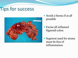 Tips for success
 Avoid a Stoma if at all
possible
 Excise all inflamed
Sigmoid colon
 Segment used for stoma
must be free of
inflammation
 