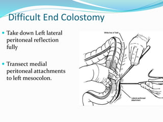 Difficult End Colostomy
 Take down Left lateral
peritoneal reflection
fully
 Transect medial
peritoneal attachments
to left mesocolon.
 