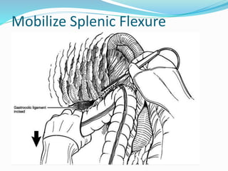 Mobilize Splenic Flexure
 
