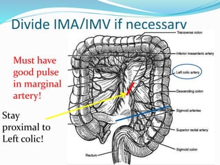 Divide IMA/IMV if necessary
Must have
good pulse
in marginal
artery!
Stay
proximal to
Left colic!
 