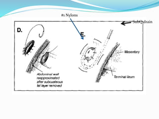 #1 Nylons
SubQ drain
 