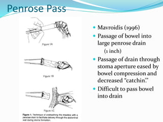 Penrose Pass
 Mavroidis (1996)
 Passage of bowel into
large penrose drain
(1 inch)
 Passage of drain through
stoma aperture eased by
bowel compression and
decreased “catchin’.”
 Difficult to pass bowel
into drain
 