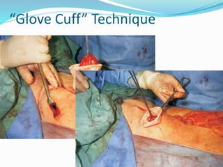 “Glove Cuff” Technique
 Horwood, et al. 2009
 