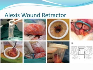 Alexis Wound Retractor
 