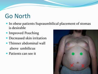 Go North
 In obese patients Supraumbilical placement of stomas
is desirable
 Improved Pouching
 Decreased skin irritation
 Thinner abdominal wall
above umbilicus
 Patients can see it
 