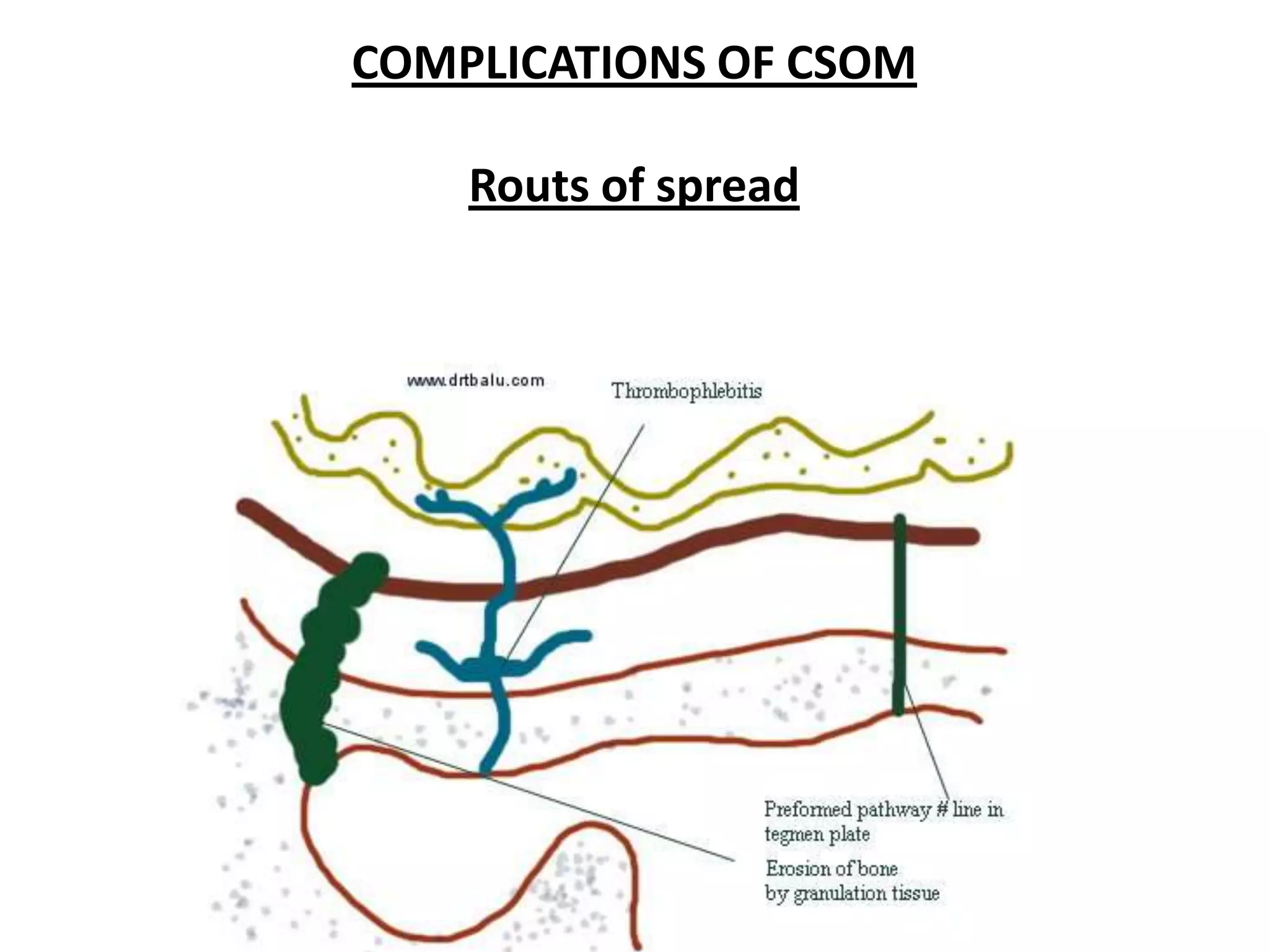 COMPLICATIONS OF CSOM

    Routs of spread
 
