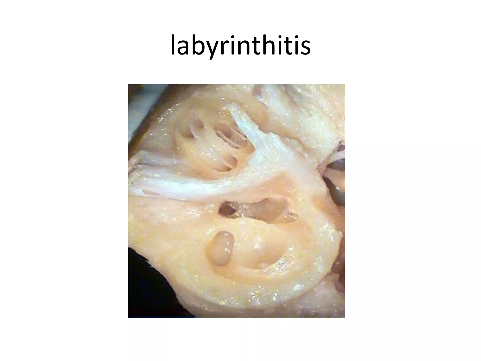 labyrinthitis
 