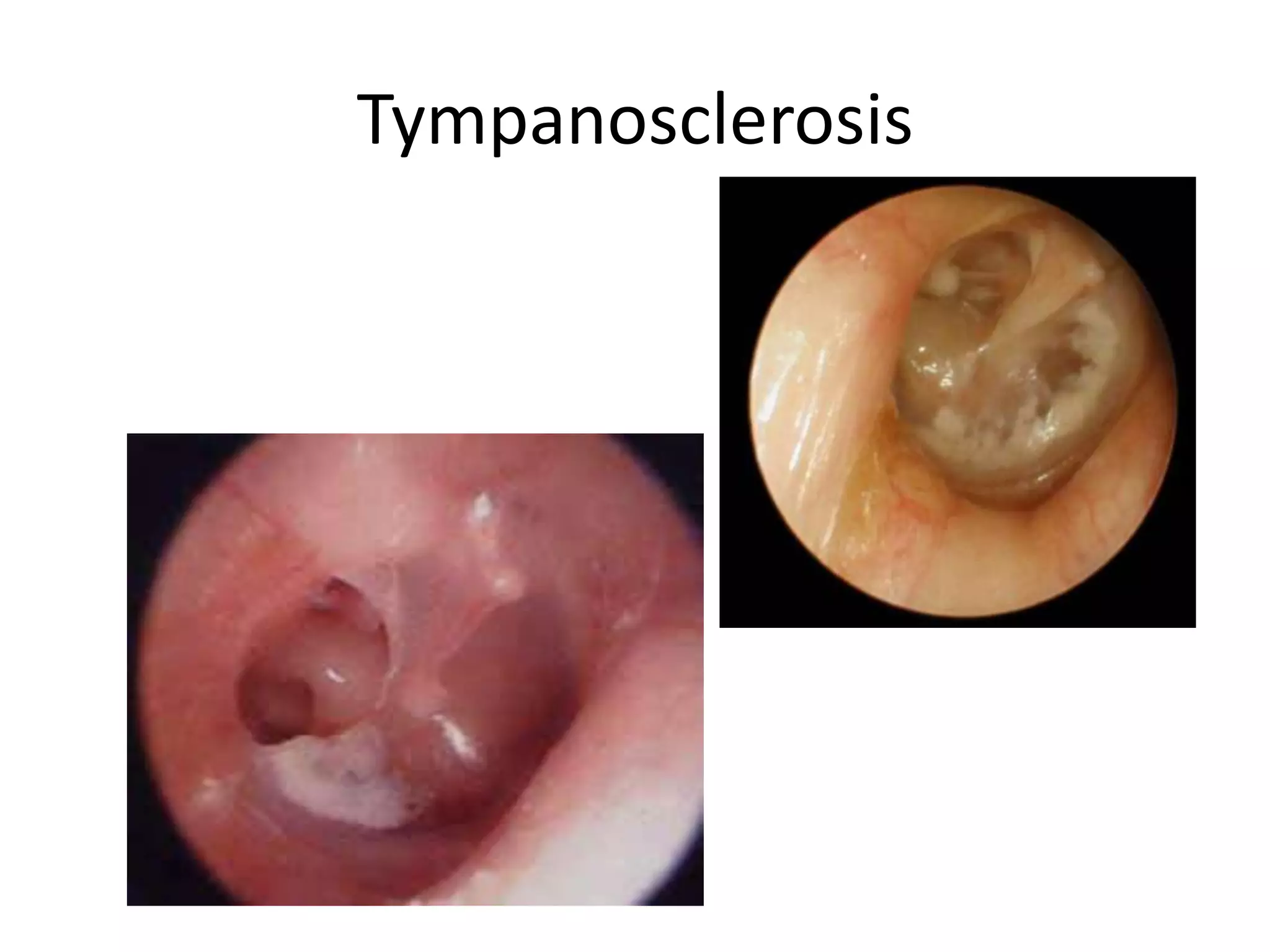 Tympanosclerosis
 