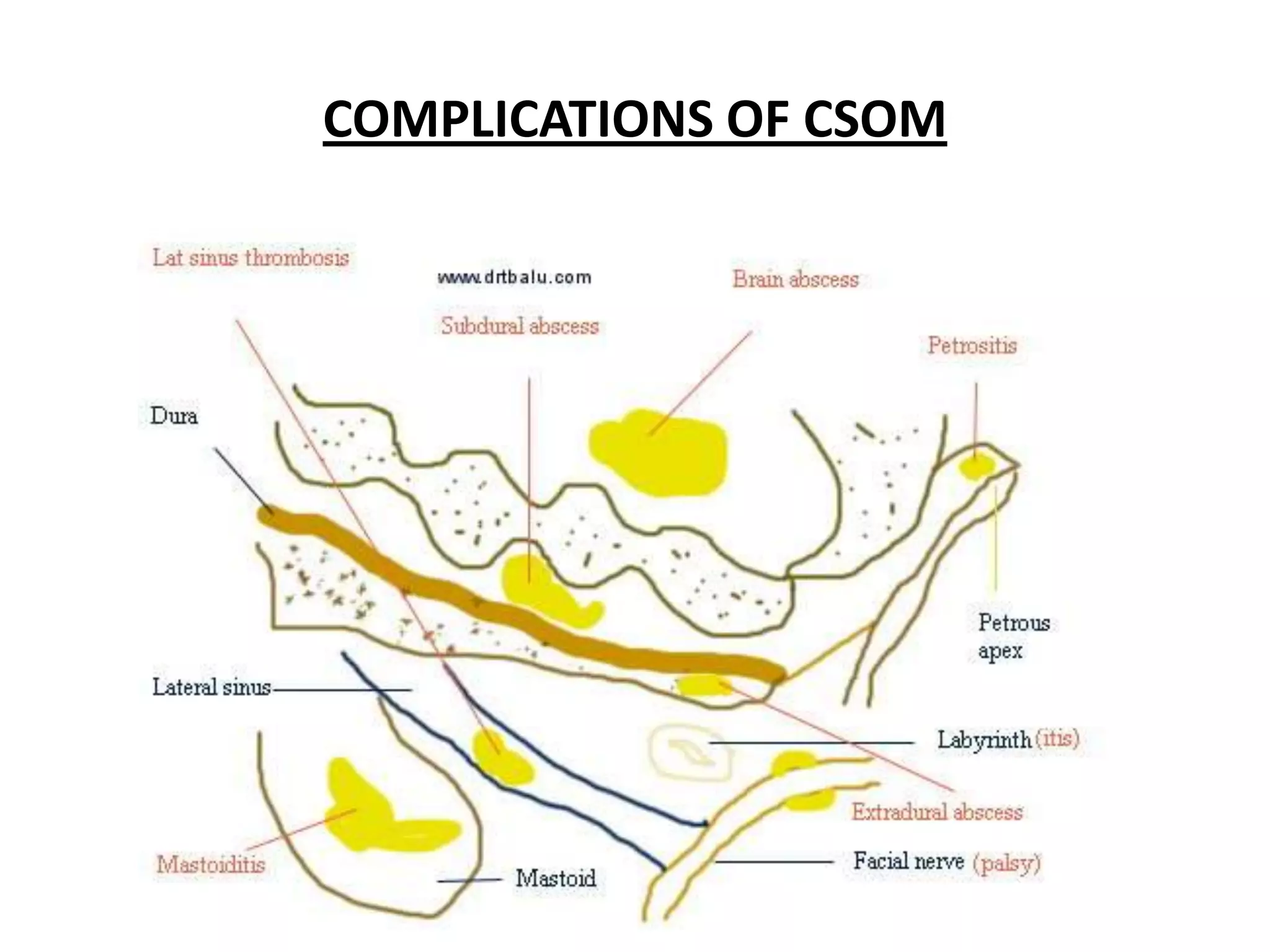 COMPLICATIONS OF CSOM
 