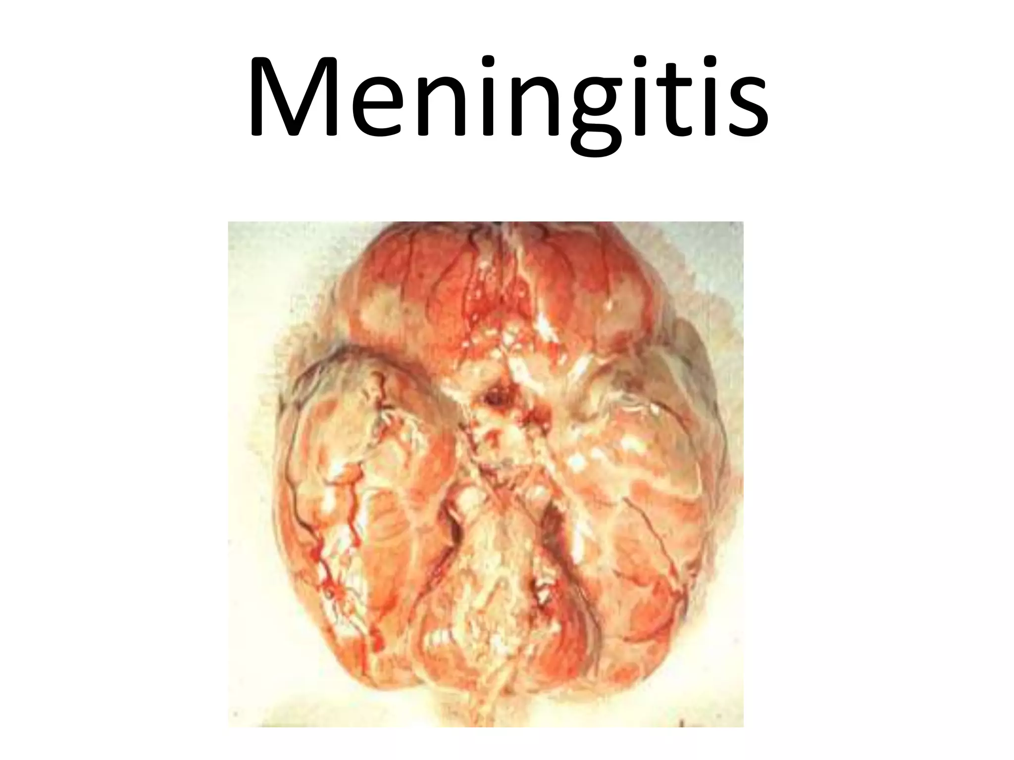 Meningitis
 