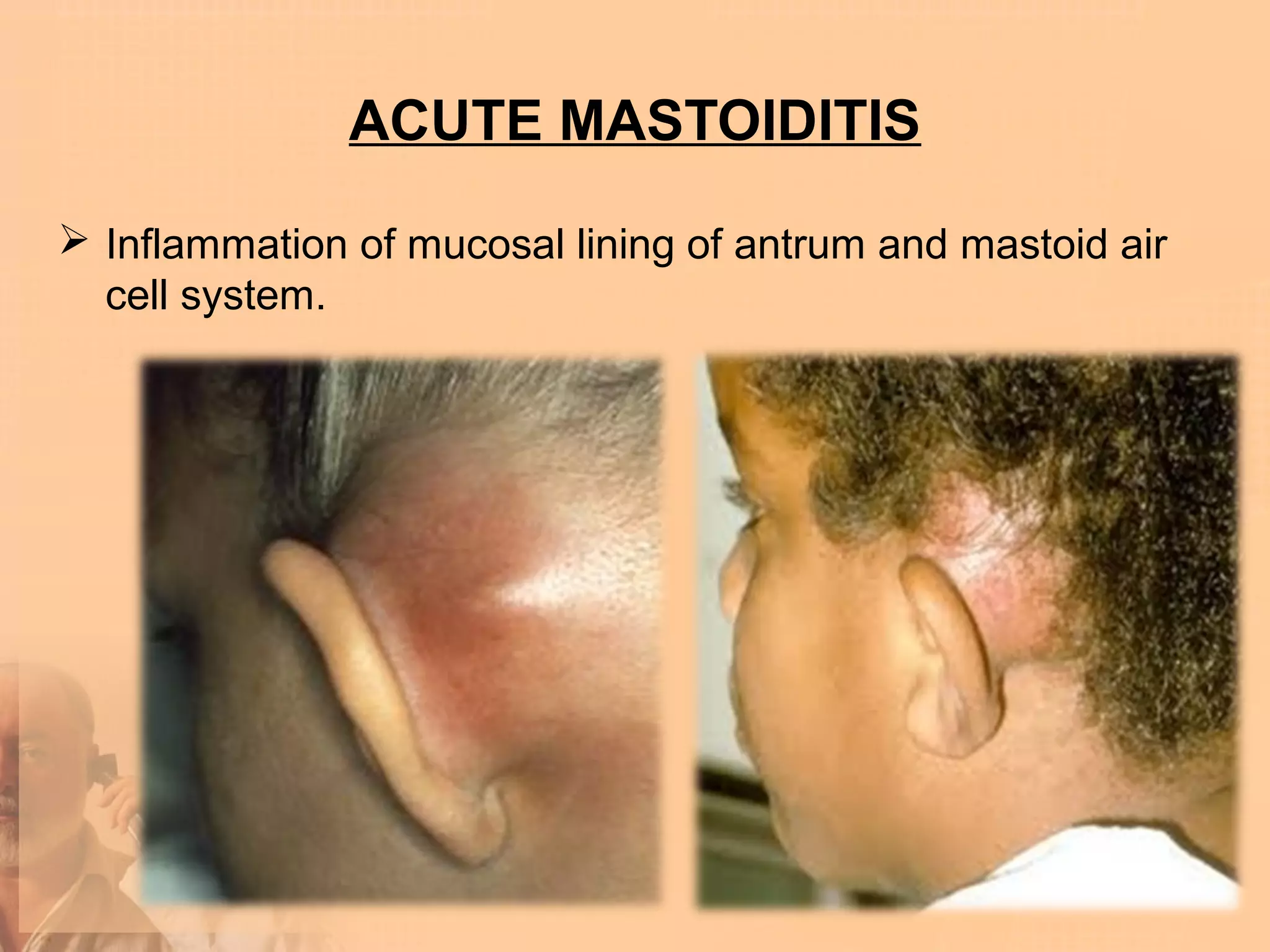 ACUTE MASTOIDITIS

 Inflammation of mucosal lining of antrum and mastoid air
  cell system.
 
