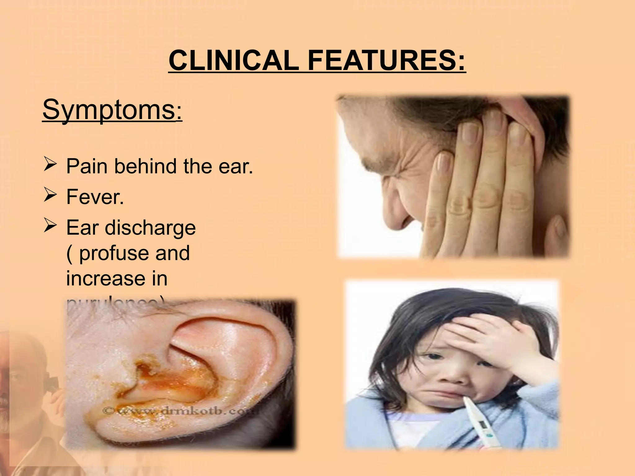 CLINICAL FEATURES:
Symptoms:
 Pain behind the ear.
 Fever.
 Ear discharge
  ( profuse and
  increase in
  purulence).
 