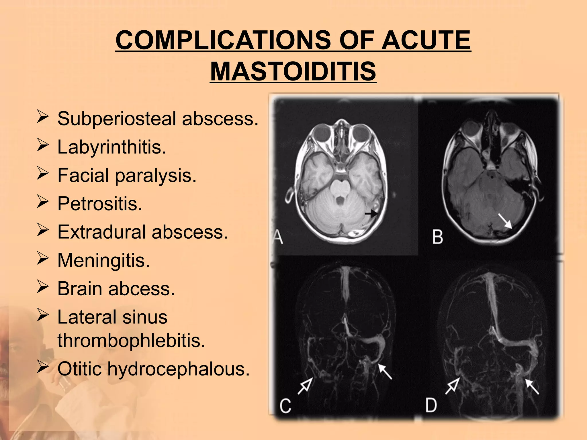 COMPLICATIONS OF ACUTE
             MASTOIDITIS
 Subperiosteal abscess.
 Labyrinthitis.
 Facial paralysis.
 Petrositis.
 Extradural abscess.
 Meningitis.
 Brain abcess.
 Lateral sinus
  thrombophlebitis.
 Otitic hydrocephalous.
 