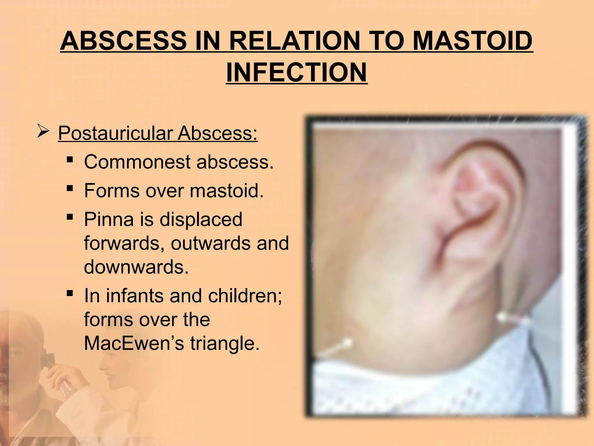ABSCESS IN RELATION TO MASTOID
             INFECTION

 Postauricular Abscess:
    Commonest abscess.
    Forms over mastoid.
    Pinna is displaced
     forwards, outwards and
     downwards.
    In infants and children;
     forms over the
     MacEwen’s triangle.
 