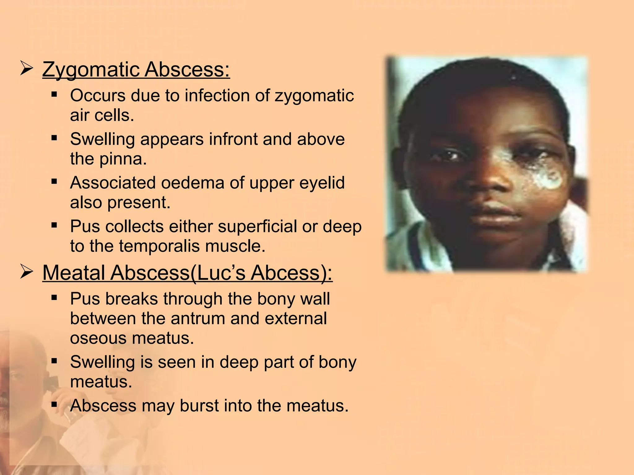  Zygomatic Abscess:
    Occurs due to infection of zygomatic
     air cells.
    Swelling appears infront and above
     the pinna.
    Associated oedema of upper eyelid
     also present.
    Pus collects either superficial or deep
     to the temporalis muscle.
 Meatal Abscess(Luc’s Abcess):
    Pus breaks through the bony wall
     between the antrum and external
     oseous meatus.
    Swelling is seen in deep part of bony
     meatus.
    Abscess may burst into the meatus.
 
