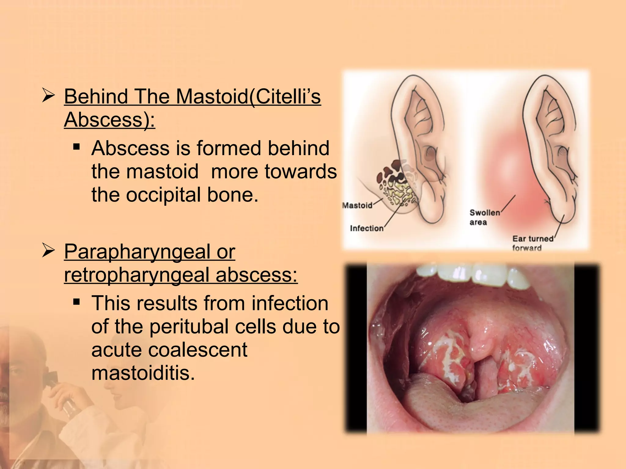  Behind The Mastoid(Citelli’s
  Abscess):
    Abscess is formed behind
     the mastoid more towards
     the occipital bone.

 Parapharyngeal or
  retropharyngeal abscess:
    This results from infection
     of the peritubal cells due to
     acute coalescent
     mastoiditis.
 