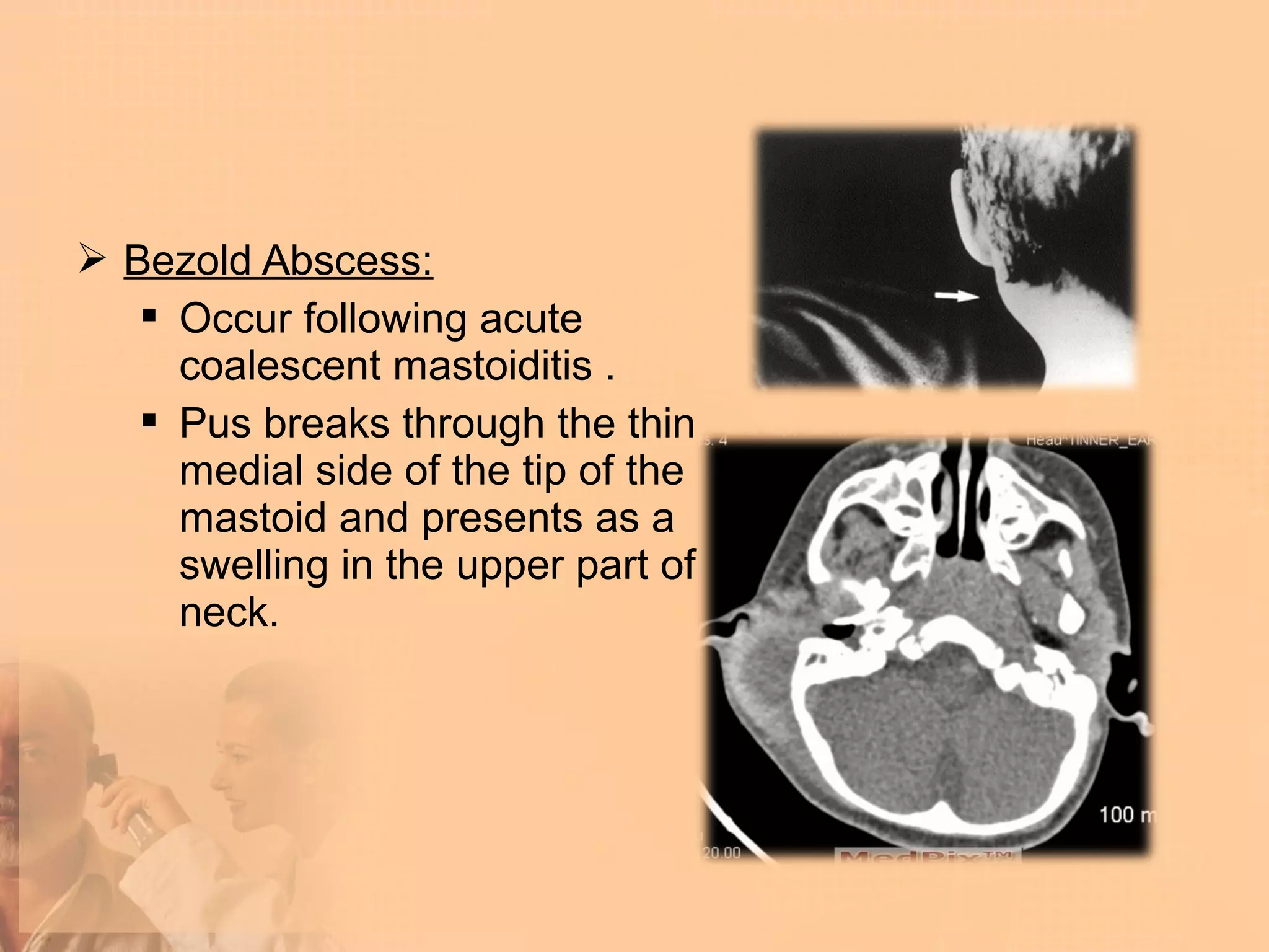  Bezold Abscess:
    Occur following acute
     coalescent mastoiditis .
    Pus breaks through the thin
     medial side of the tip of the
     mastoid and presents as a
     swelling in the upper part of
     neck.
 