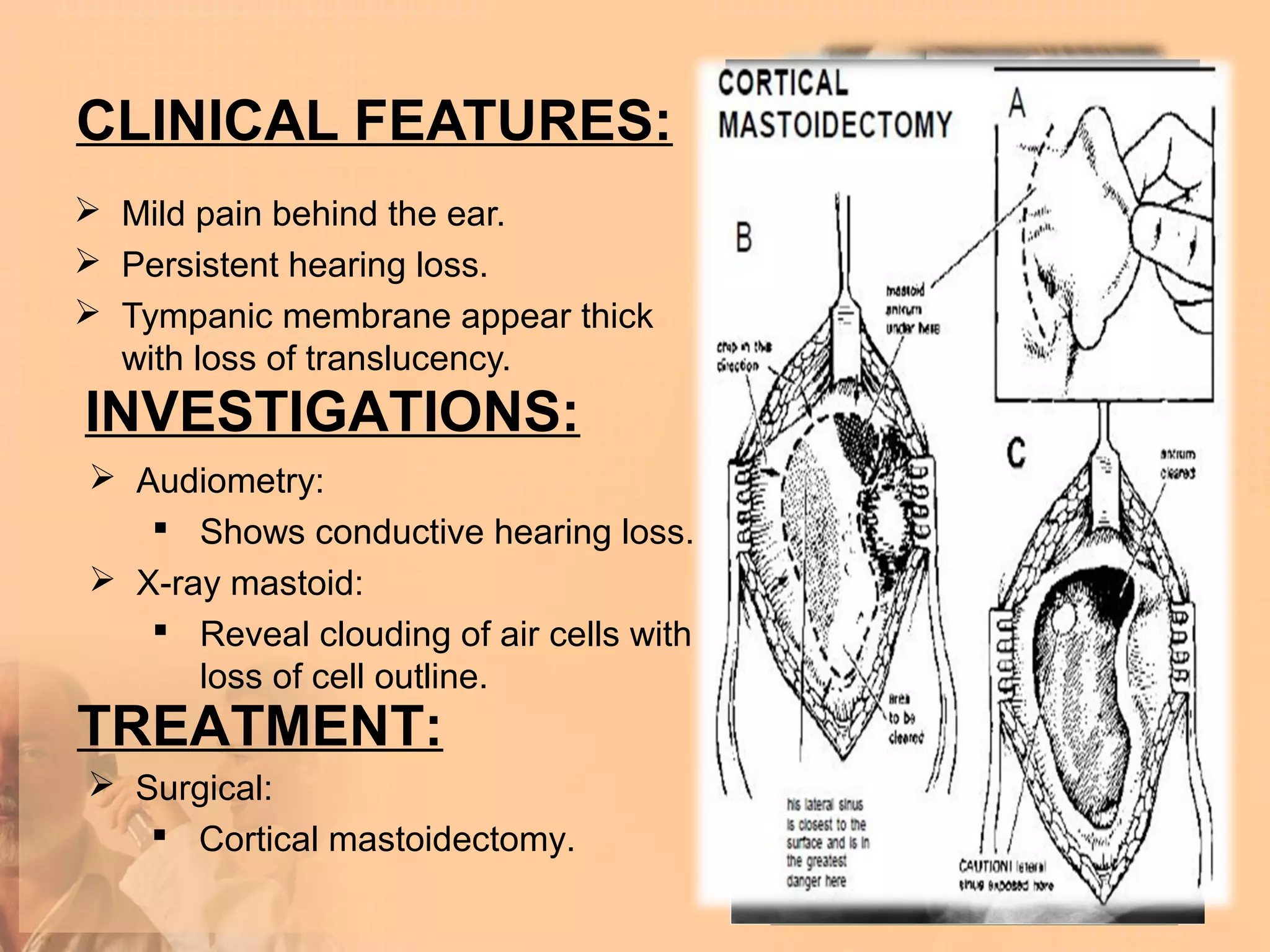 CLINICAL FEATURES:
 Mild pain behind the ear.
 Persistent hearing loss.
 Tympanic membrane appear thick
  with loss of translucency.
INVESTIGATIONS:
 Audiometry:
    Shows conductive hearing loss.
 X-ray mastoid:
    Reveal clouding of air cells with
      loss of cell outline.
TREATMENT:
 Surgical:
    Cortical mastoidectomy.
 
