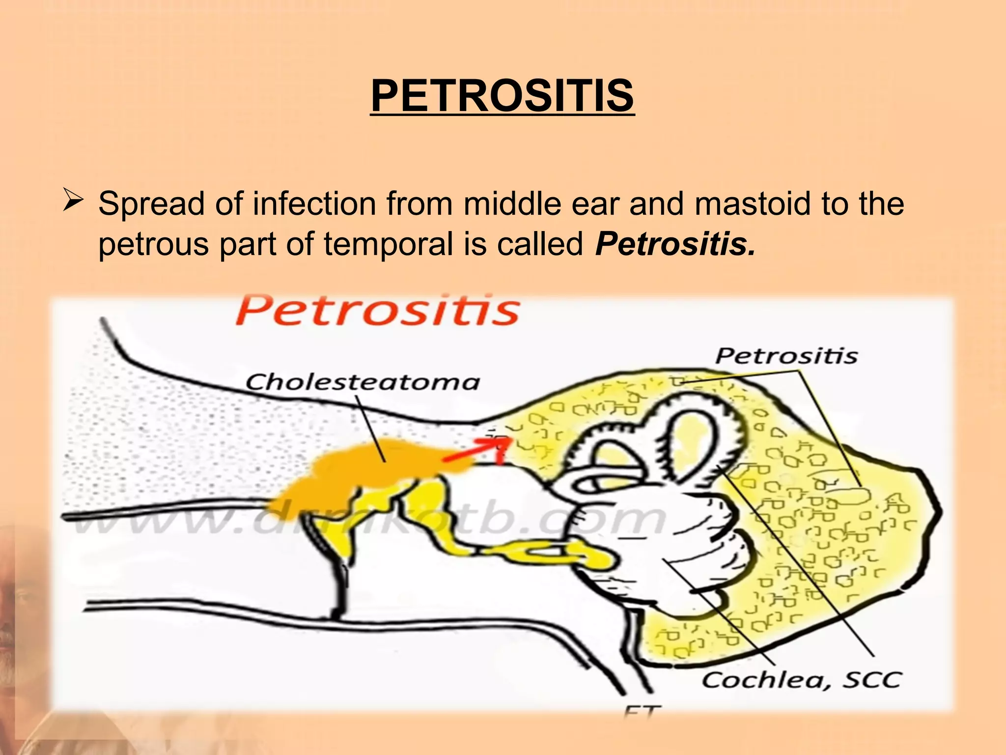 PETROSITIS

 Spread of infection from middle ear and mastoid to the
  petrous part of temporal is called Petrositis.
 