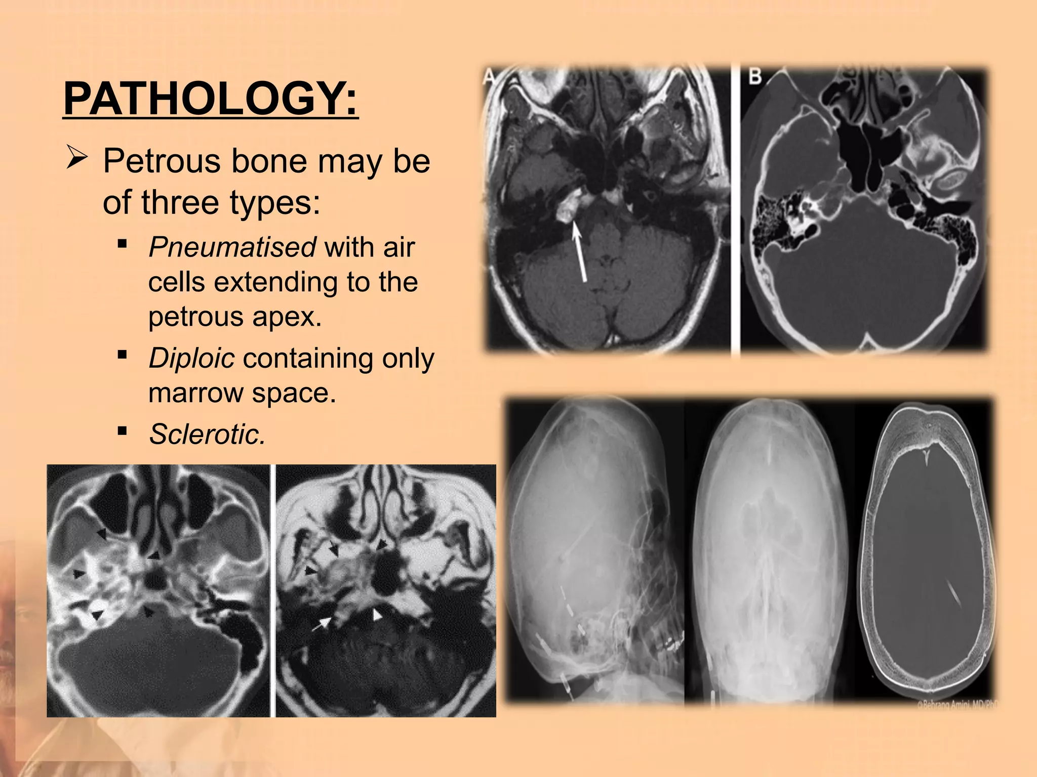 PATHOLOGY:
 Petrous bone may be
  of three types:
   Pneumatised with air
    cells extending to the
    petrous apex.
   Diploic containing only
    marrow space.
   Sclerotic.
 