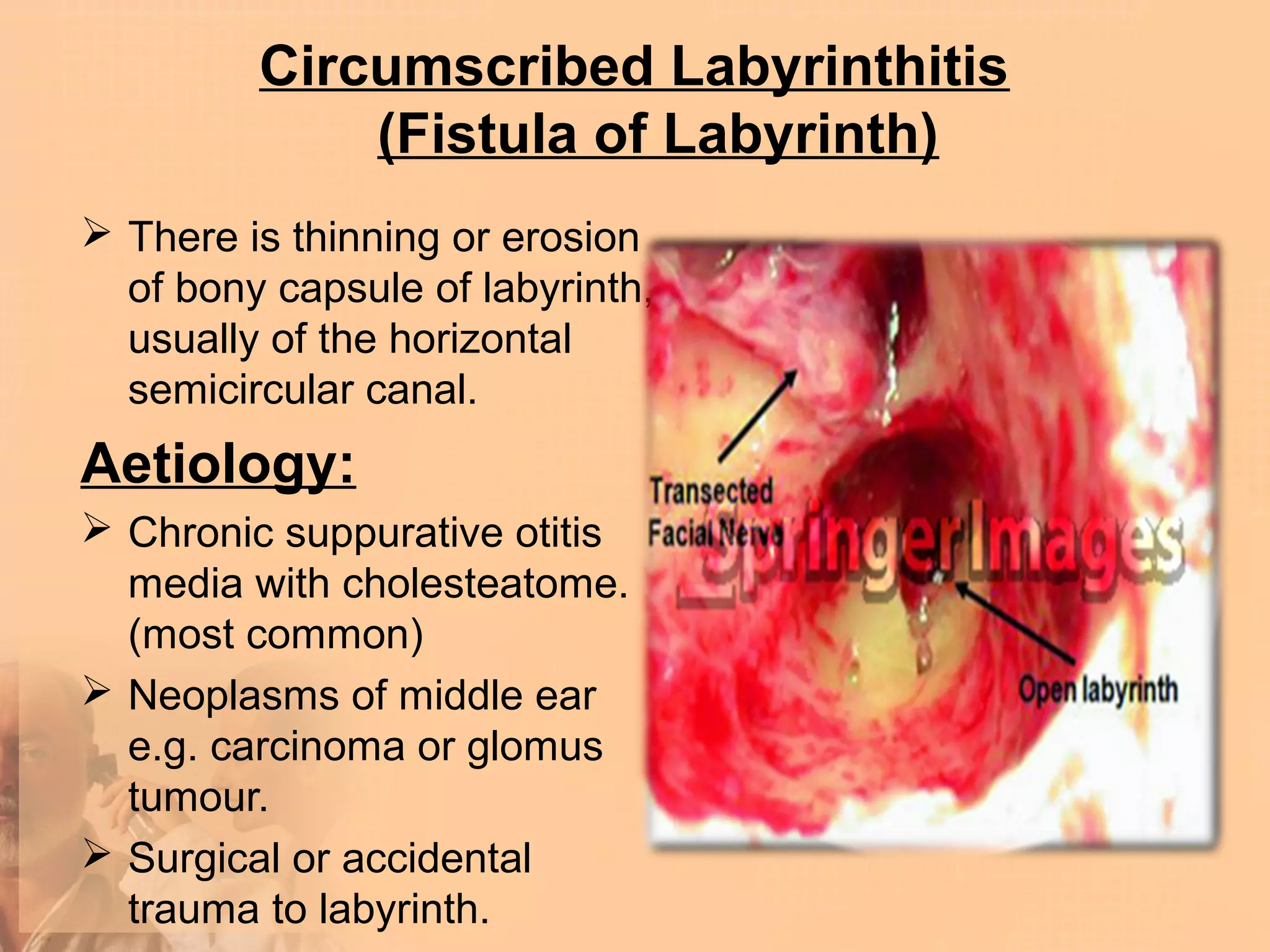 Circumscribed Labyrinthitis
             (Fistula of Labyrinth)
 There is thinning or erosion
  of bony capsule of labyrinth,
  usually of the horizontal
  semicircular canal.
Aetiology:
 Chronic suppurative otitis
  media with cholesteatome.
  (most common)
 Neoplasms of middle ear
  e.g. carcinoma or glomus
  tumour.
 Surgical or accidental
  trauma to labyrinth.
 