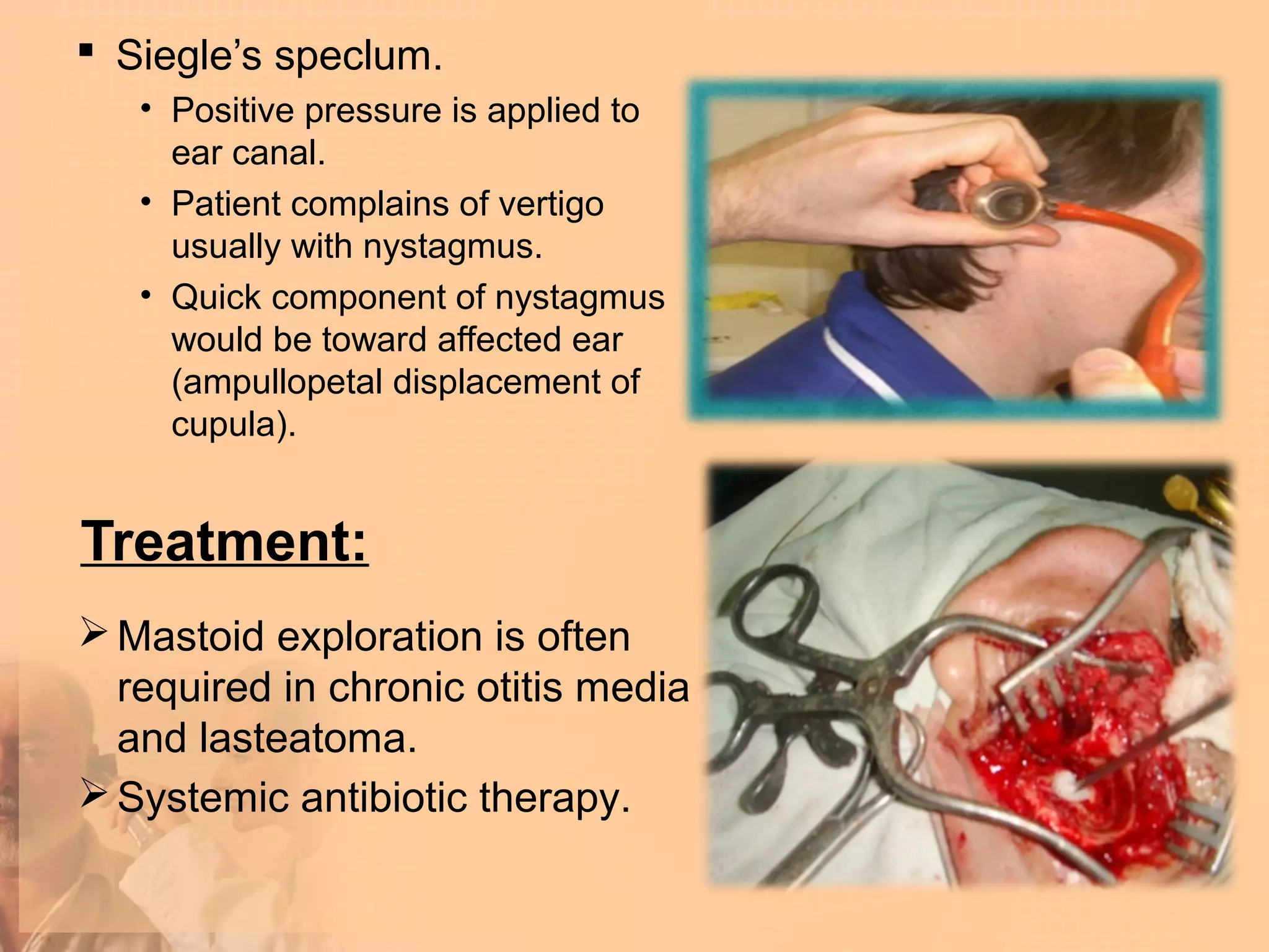  Siegle’s speclum.
   • Positive pressure is applied to
     ear canal.
   • Patient complains of vertigo
     usually with nystagmus.
   • Quick component of nystagmus
     would be toward affected ear
     (ampullopetal displacement of
     cupula).


Treatment:
 Mastoid exploration is often
  required in chronic otitis media
  and lasteatoma.
 Systemic antibiotic therapy.
 