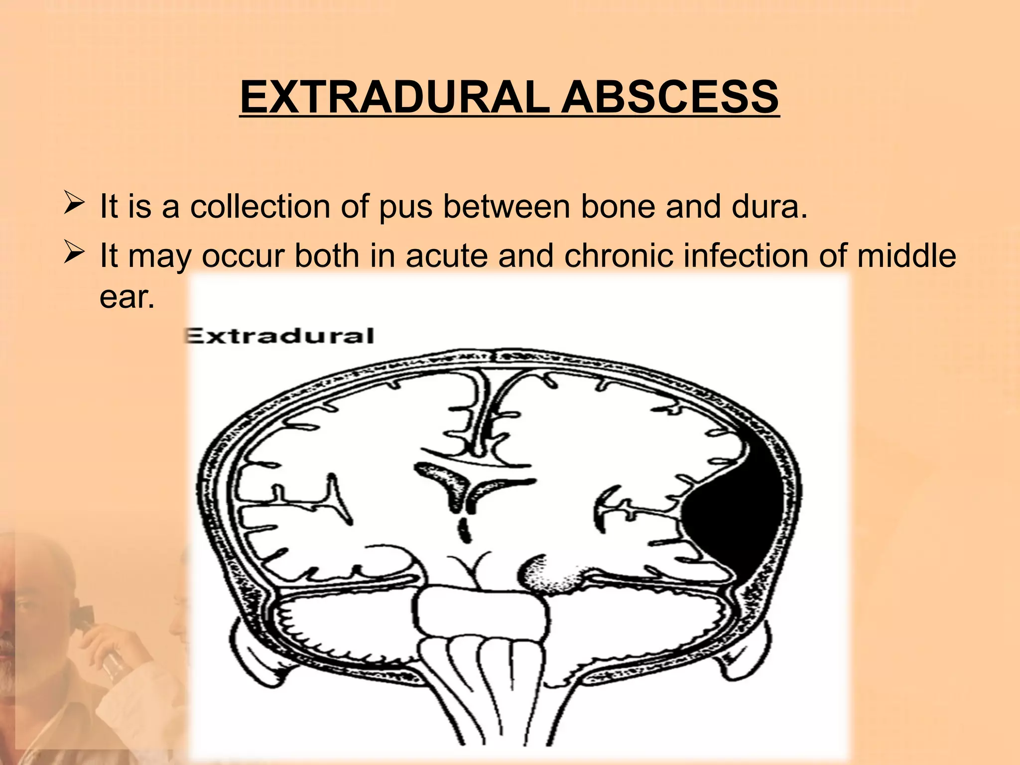 EXTRADURAL ABSCESS

 It is a collection of pus between bone and dura.
 It may occur both in acute and chronic infection of middle
  ear.
 