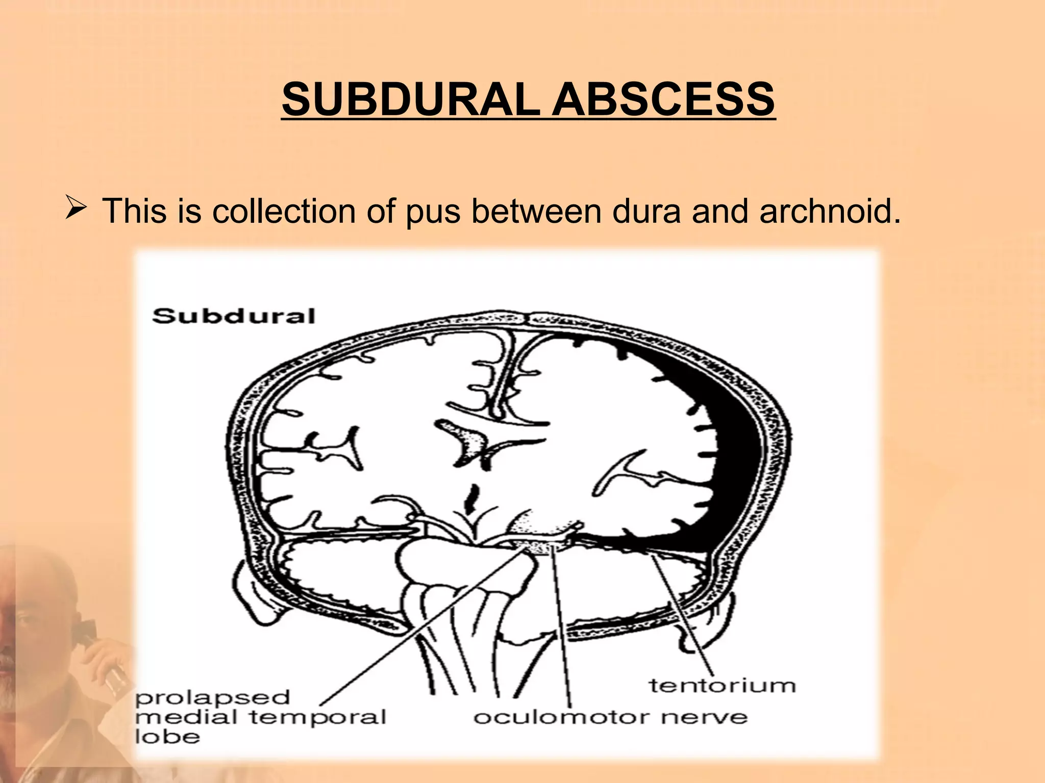 SUBDURAL ABSCESS

 This is collection of pus between dura and archnoid.
 