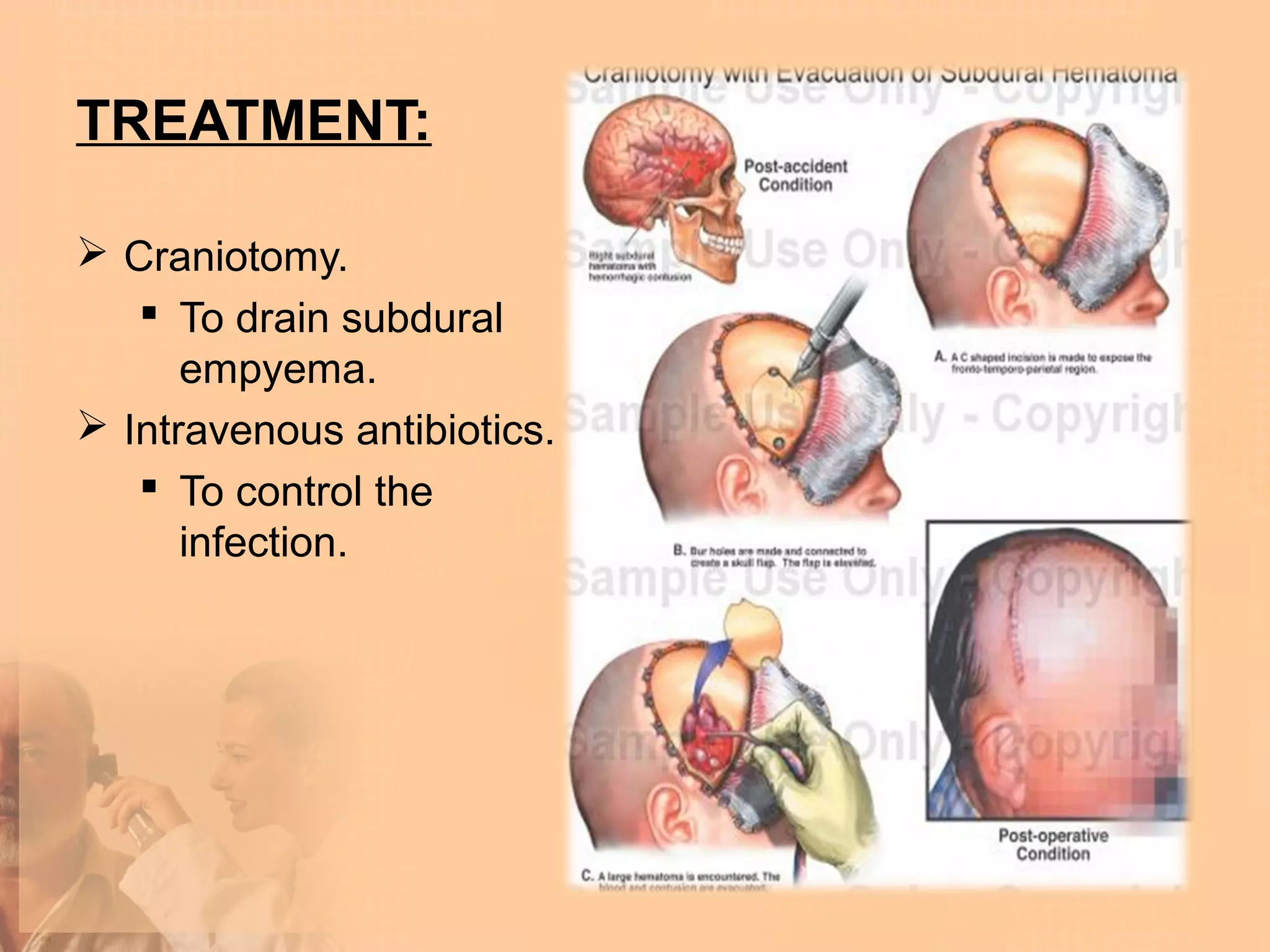 TREATMENT:

 Craniotomy.
    To drain subdural
      empyema.
 Intravenous antibiotics.
    To control the
      infection.
 