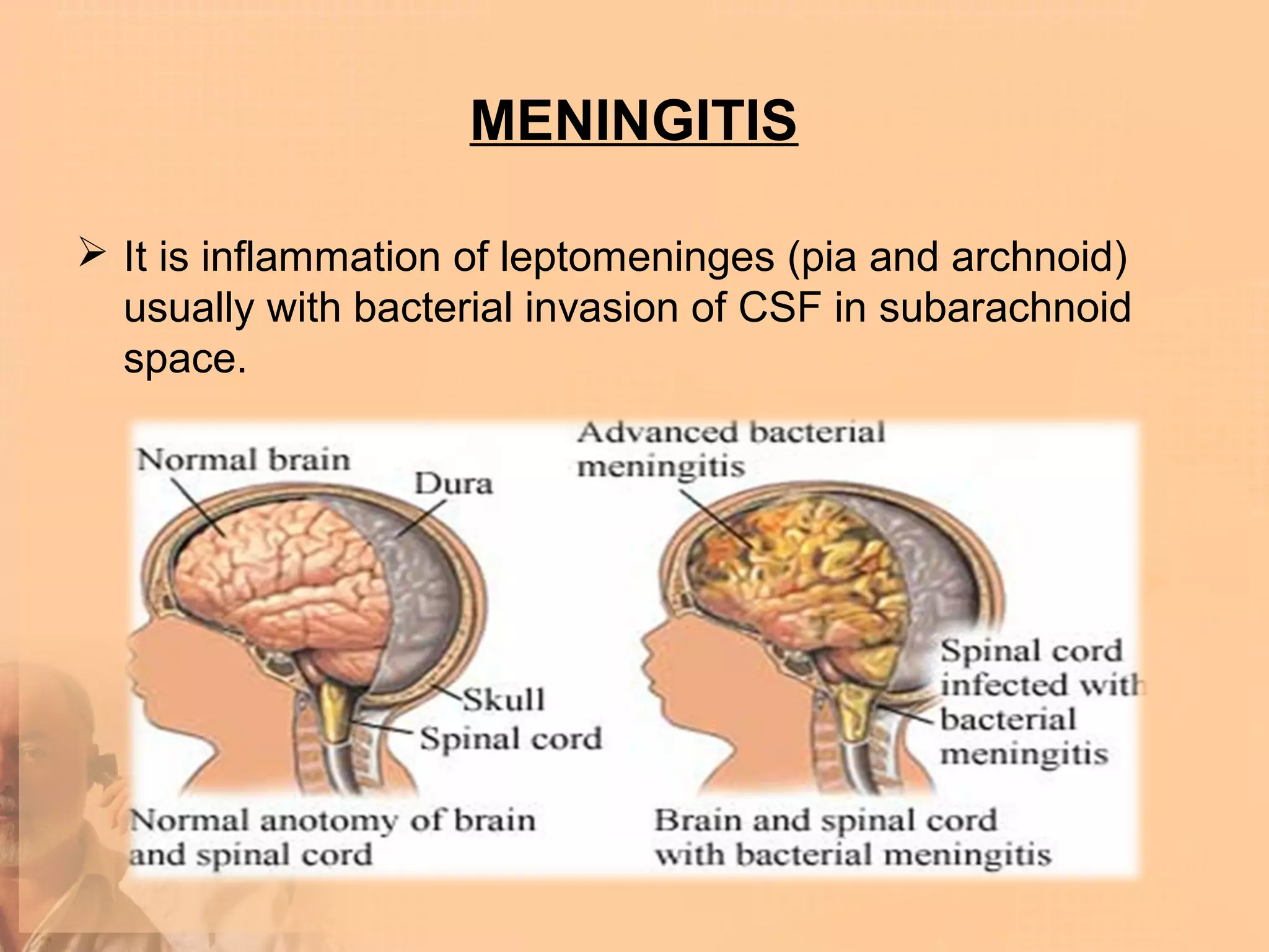MENINGITIS

 It is inflammation of leptomeninges (pia and archnoid)
  usually with bacterial invasion of CSF in subarachnoid
  space.
 