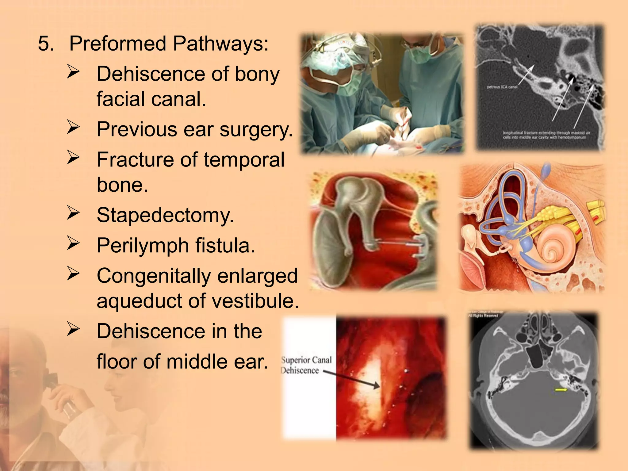 5. Preformed Pathways:
    Dehiscence of bony
      facial canal.
    Previous ear surgery.
    Fracture of temporal
      bone.
    Stapedectomy.
    Perilymph fistula.
    Congenitally enlarged
      aqueduct of vestibule.
    Dehiscence in the
      floor of middle ear.
 