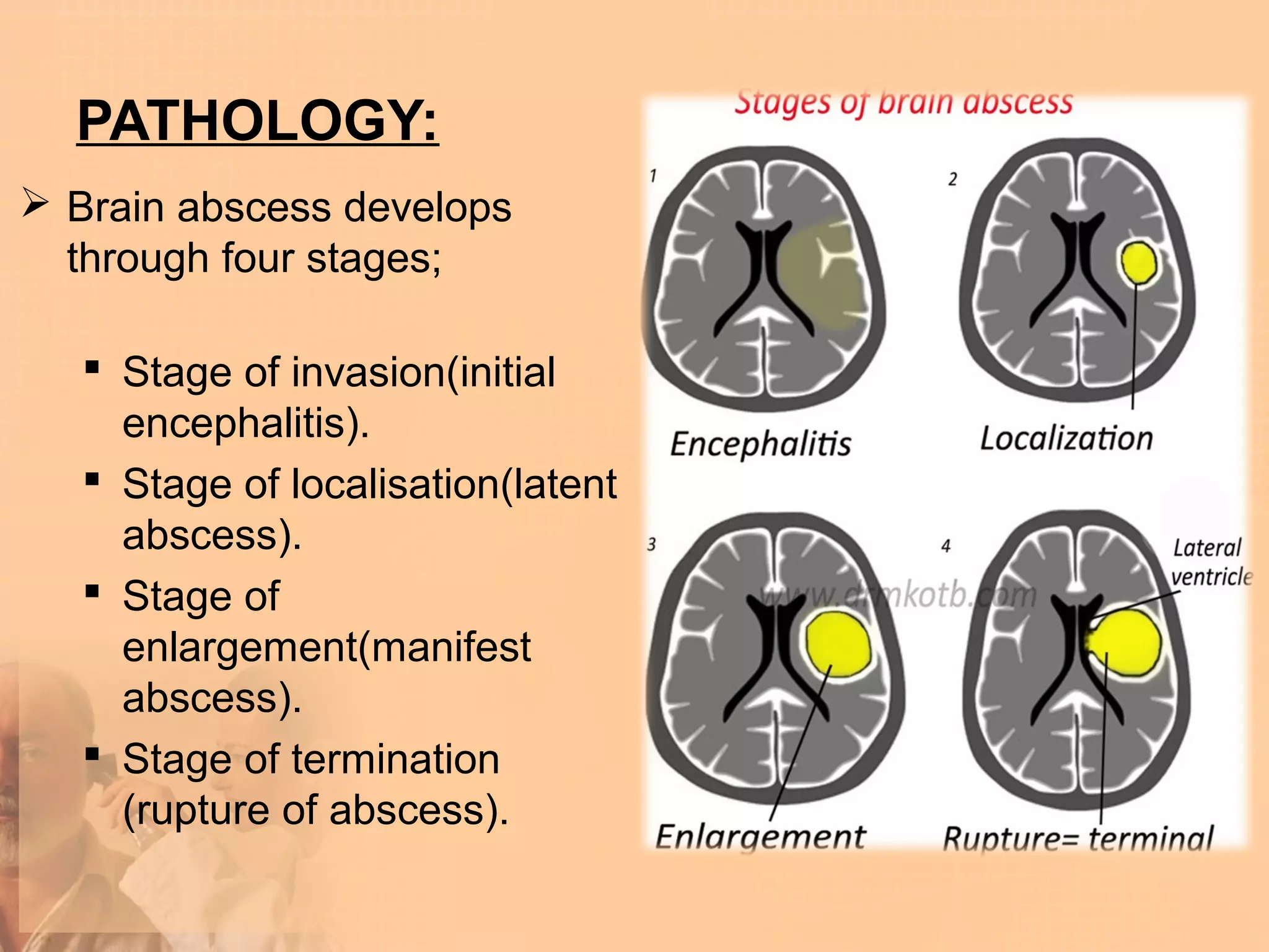 PATHOLOGY:
 Brain abscess develops
  through four stages;

    Stage of invasion(initial
     encephalitis).
    Stage of localisation(latent
     abscess).
    Stage of
     enlargement(manifest
     abscess).
    Stage of termination
     (rupture of abscess).
 